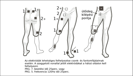 Elektr&oacute;da felhelyez&eacute;s