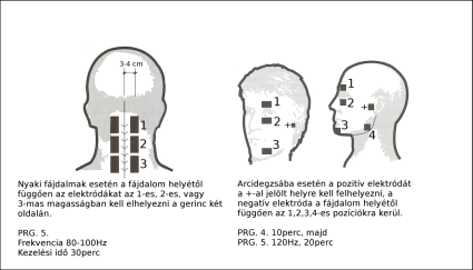Elektr&oacute;da felhelyez&eacute;s