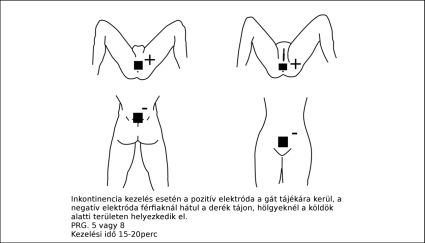 Elektr&oacute;da felhelyez&eacute;s