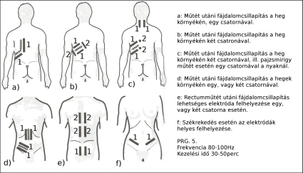 Elektr&oacute;da felhelyez&eacute;s